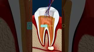 Удаление НЕРВА Зуба  (как происходит)  #shorts #факты #удаление #зубы #интересно