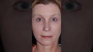 AMAZING Facelift RESULTS Revealed by OculoFacial Plastic Surgeon