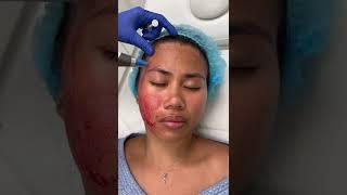 How To Get Glowing Skin - Watch Our Nurse Performs Microneedling Treatment | Skin Care Tips
