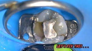 LIVE: Molar Root Canal Treatment | Tooth Decay BENEATH Silver Filling. . .