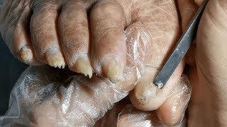 Grandpa Has Rusty Nail Fungus? You Need To Clip Like This..