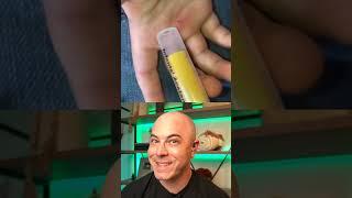 Doctor reacts to using the syringe method for splinter removal! #dermreacts #doctorreacts #splinter