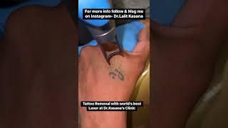 World’s best laser for Tattoo Removal Treatment at Dr  Kasana’s Clinic