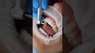 Composite Bonding in London #compositebonding #dentist #london #veneers