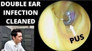 Sloughy Pus Ear Infection Cleaned