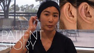 Revision Otoplasty For Prominent Ear Correction | Ear Fold Surgery Patient Testimonial