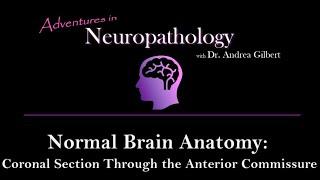 Normal Neuro Anatomy - Coronal Section of the Brain Through the Anterior Commissure