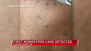 Monkeypox confirmed in Olmsted County