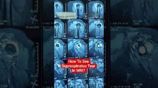 How To See Supraspinatus Tear In MRI?  Dr Sai Chandra MBBS DNB Ortho Hyderabad 9573517107