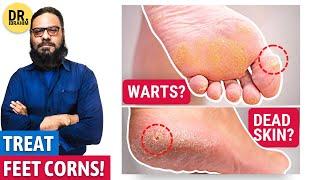 Treat Foot Corns (WARTS or CALLUSES?!) Foot Corn Ka Ilaj | Urdu/Hindi | Dr. Ibrahim