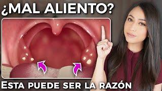 Bad breath? You might have TONSIL STONES, what causes them? How to remove them?l  Dr Pau Zúñiga‍️