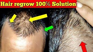 how to regrow hair naturally for men | how to regrow hair in bald area | How to regrow hairline