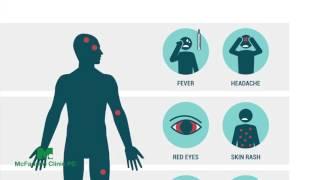 What do I need to know about the Zika Virus? | McFarland Clinic