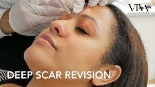 VIVA Skin Clinics | Deep Scar Revision