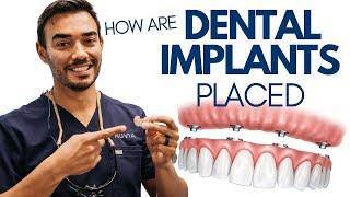 5 Things to Expect During Dental Implant Surgery