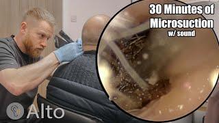 30 Minutes of MICROSUCTION Ear Wax Removal