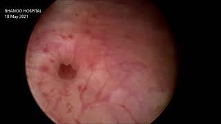 Cystoscopy