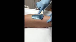 Hair Removal Waxing By Dr. Su Sachar