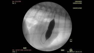 Ballon valvuloplasty of the pulmonary artery. Баллонная вальвулопластика.