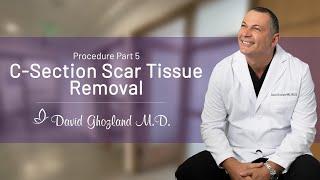 C-Section Scar Tissue Removal | Procedure Part 5 | David Ghozland, M.D.