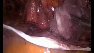 TAP and laparoscopic anatomy of the groin .Wael Tobar MD