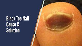 BLACK TOE NAILS - CAUSES AND SOLUTIONS