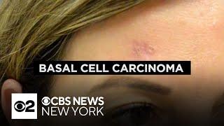 Dermatologist explains the dangers of basal cell carcinoma, what to look out for