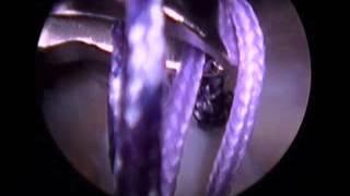 rotator cuff repair video, Dr. Brett Sanders