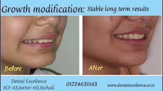 Removable functional appliances like twin block, frankel - Dental Excellence Mohali
