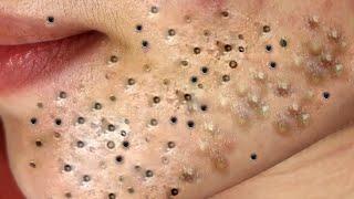 ACNE CLEANING - KINISH TV  #kinishacne 2023 new video #5