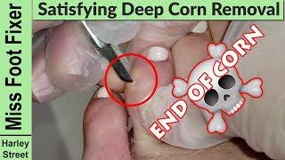 Satisfying and gentle corn removal | foot corn removal By Miss Foot Fixer Marion Yau