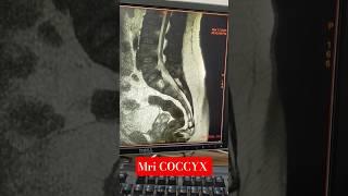 MRI COCCYX #tailbonepain #tails #anatomy  #coccyx #pain