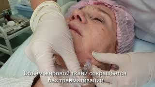 Инъекционная коррекция MesoSculpt "второго подбородка" в Центре косметологии ALTEOS Beauty