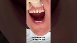 Porcelain veneers front teeth | porcelain veneers process | Dr. Yazdan | #cosmeticdentistry #veneers