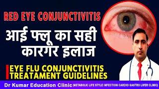 EYE FLU CONJUNCTIVITIS TREATAMENT GUIDELINES//आई फ्लू का सही कारगर इलाज