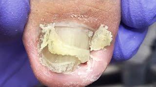 Oversized ingrown nails, professional pedicure dug out, very comfortable【Doctor Liu Pedicure】