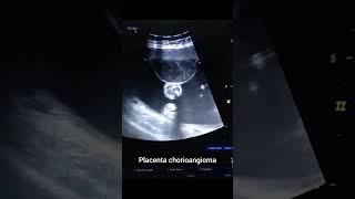 placenta chorioangioma#imaging #ultrasound #medicalimaging #learning #medicine #viral #gynecologist