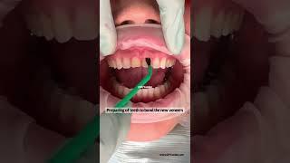 Porcelain veneer process | porcelain veneer procedure | Dr. Yazdan | veneers before and after