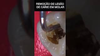 REMOÇÃO DE CÁRIE DENTAL #oral #bucal #lesaodecarie #bucal #shortsfeed #shortsviral #carie #odontolog