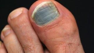 How to Prevent & Treat Black Toenail | Foot Care