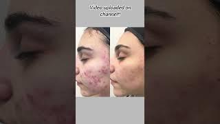 You can get rid of acne naturally!!