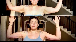 Brachioplasty (Arm Lift) before and after | 3day, 3wk, & 8wk recovery progress | PCOS weightloss