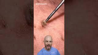 Satisfying impacted hair removal from the armpit!(credit: @blemishbandits on TT) #doctor #satisfying