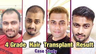 Case Study: Day 0 to 8 Month Progress Result | Best Hair Transplant Result