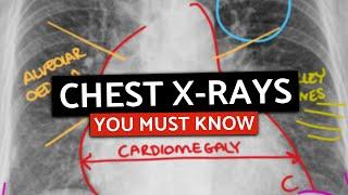 10 MUST KNOW Chest X-Rays For Medical/PA Finals | CXRs Made Easy