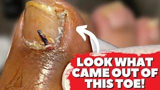 DEEP Thorn Removal From Toe!!  (Home Remedy To Remove Foreign Body From Toe)