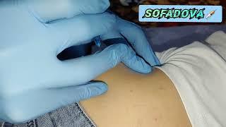 How to Give an IM intramuscular injection in the Buttocks. Dorsogluteal injection technique