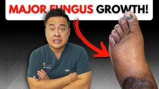 How to Get Rid of Toenail Fungus for Good | Dr. Binh's Expert Advice & Treatment Options