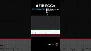 What to Look for in an AFib ECG