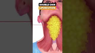 Get rid of Double Chin with 30 minutes Liposuction procedure! #doublechin #doublechinliposuction